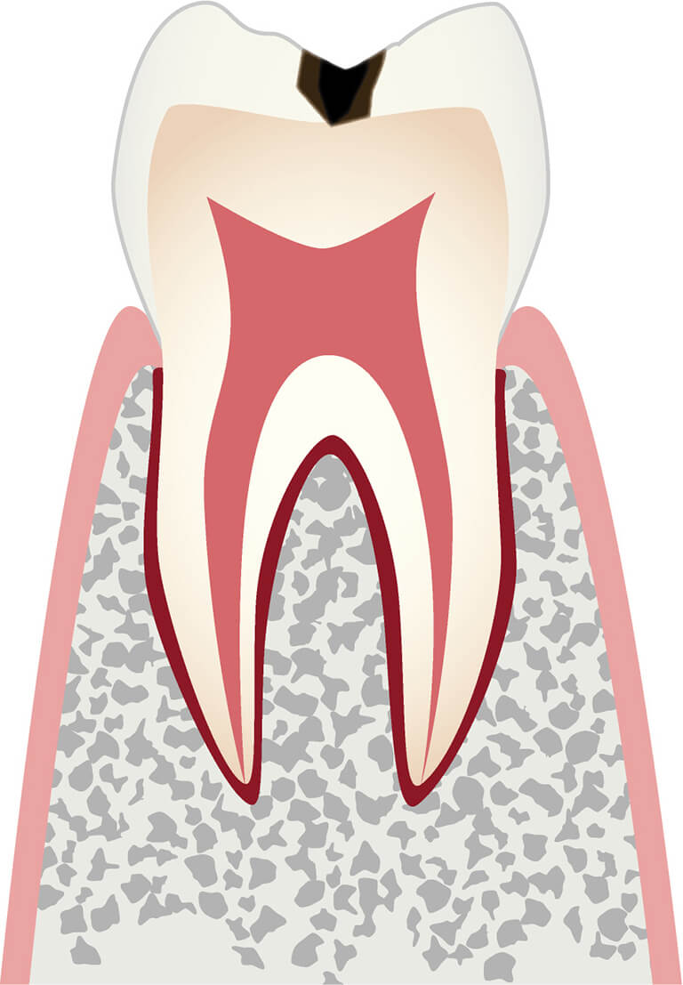 C1エナメル質に小さな穴が空いたむし歯