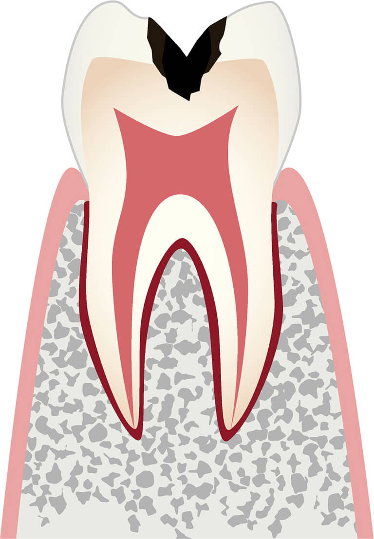 C2歯の内部（象牙質）まで進行したむし歯